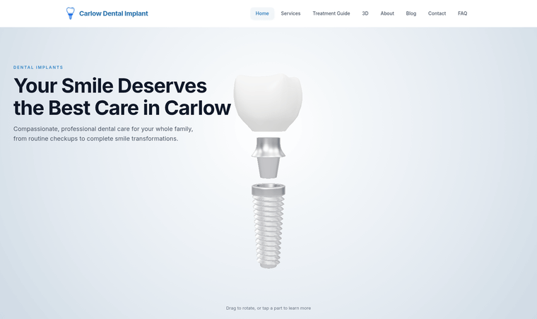 Carlow Dental Implant